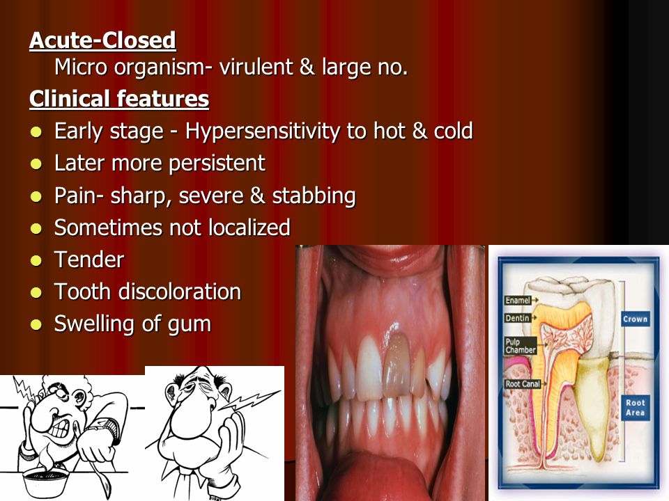 PULPITIS Inflammation of dental pulp Main source for dental pain